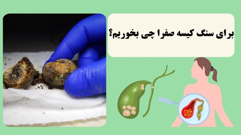 برای دفع سنگ کیسه صفرا چه بخوریم؟